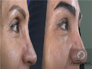 کاشت مو و ابرو با پرداخت 8 تومن و قسطی